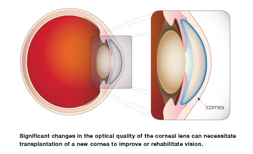 corneal