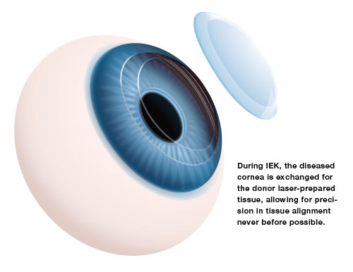 corneal