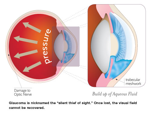 Glaucoma Surgery