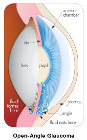 Glaucoma