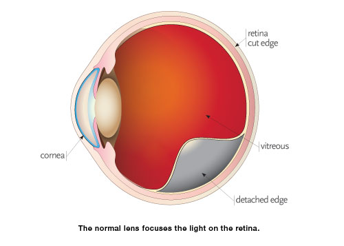 What is the Retina? Retinal detachment and other retinal issues.