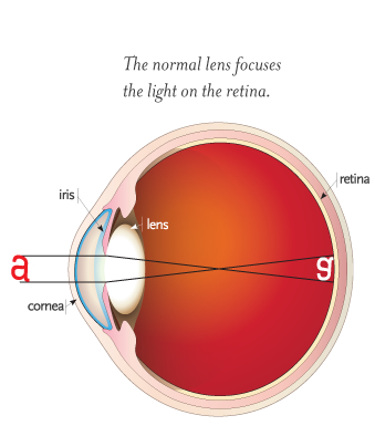 cataract1