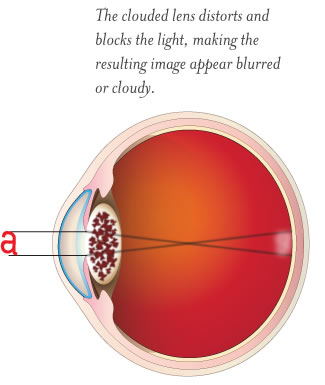 cataract2